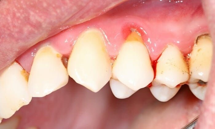 ¿Son los dientes flojos una señal de una enfermedad de las encías?