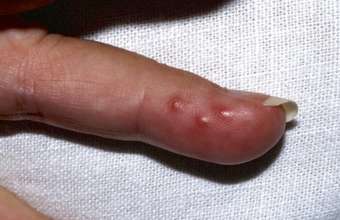 Infecciones rojas y ardientes en los dedos: lo que puede ser y lo que puede hacer con respecto a ellas