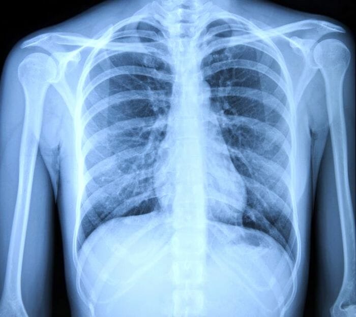¿Cómo se presentará en una radiografía de tórax?