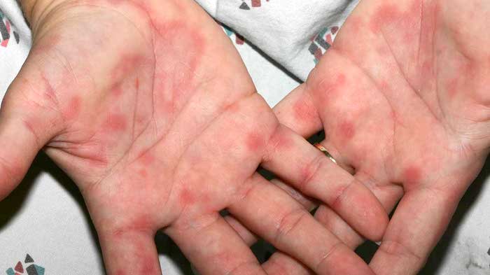 Dermatitis por contacto: cuando el contacto con ciertos productos causa una reacción alérgica