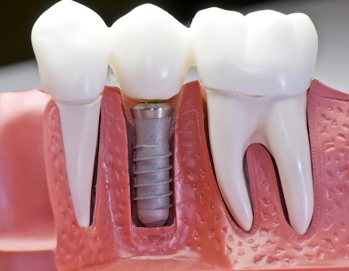 ¿Puede la enfermedad de encias (periodontal) arruinar los implantes dentales existentes? ¿Hace que los nuevos sean imposibles?