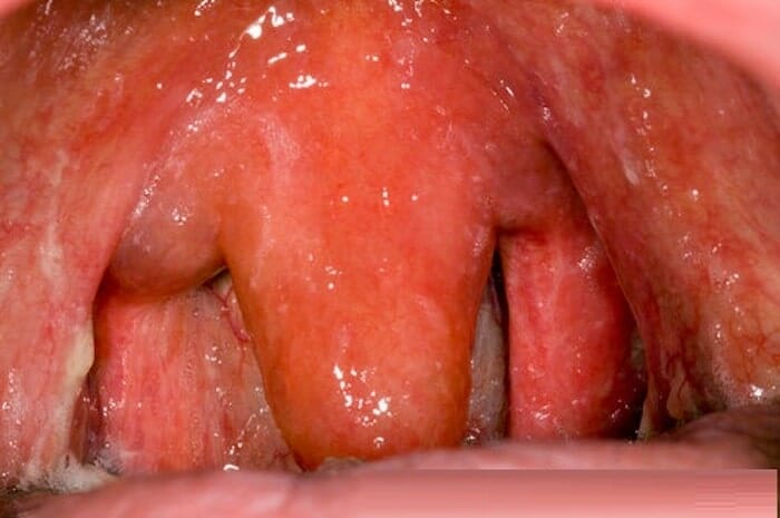 Inflamación y agrandamiento de la úvula y qué se hace al respecto
