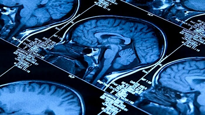 Usando imágenes por resonancia magnética, los investigadores pudieron ver que la nueva droga retrasa la contracción del cerebro en personas con EM