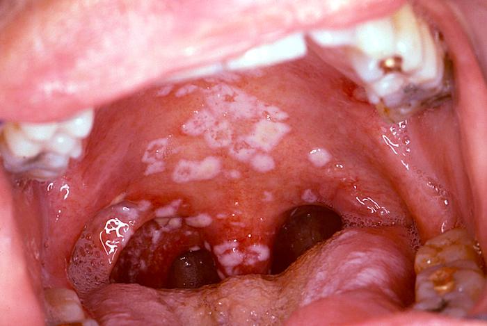 La candidiasis oral puede causar protuberancias blancas en la boca