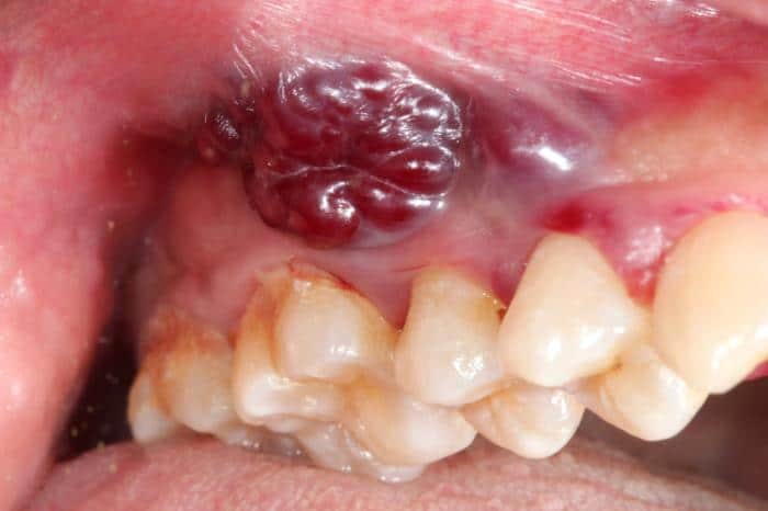 Los signos de cáncer oral pueden incluir una llaga que no cicatriza y un parche de tejido de forma extraña