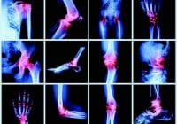 La artritis reumatoide causa dolor, enrojecimiento e hinchazón en las articulaciones y una sensación de malestar general