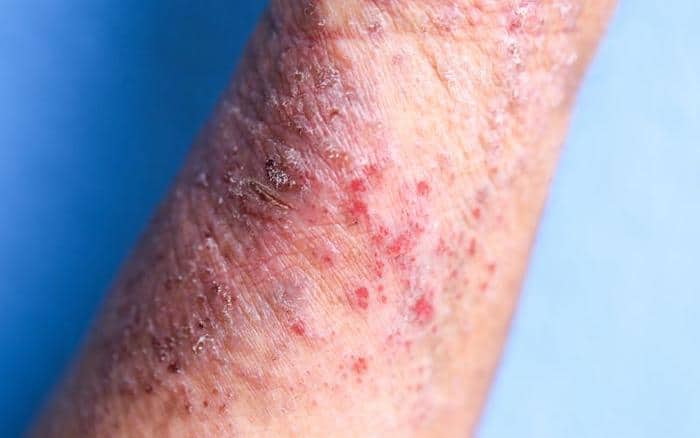 Los baños de lejía pueden ayudar a tratar el eczema cuando se usan de manera segura