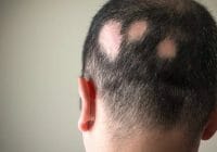 ¿Qué causa la alopecia areata?