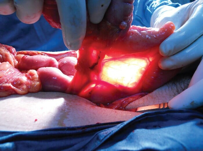 La cirugía IPAA es un procedimiento que evita la necesidad de una bolsa de ostomía permanente.