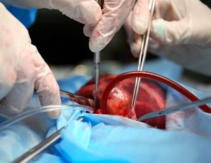 Un nuevo análisis investiga el impacto de la cirugía cardíaca en el rendimiento cognitivo