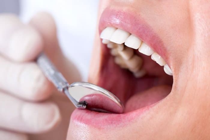 Un estudio reciente investiga un nuevo factor de riesgo para el cáncer de boca
