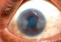 Pannus es un crecimiento anormal de tejido que puede formarse en el ojo.