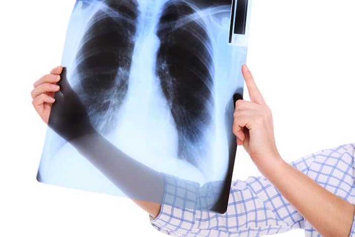 Un médico puede recomendar una radiografía de pulmón para ayudar a diagnosticar la EPOC.