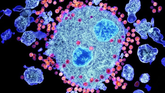 La terapia combinada de anticuerpos produce una supresión viral a largo plazo en la infección por VIH