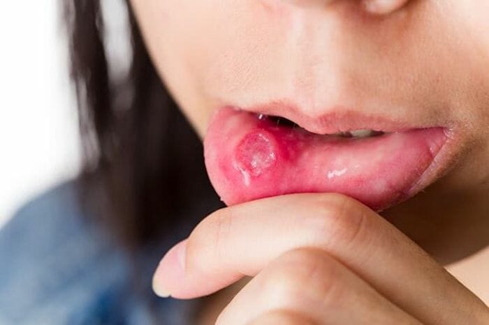 Las úlceras en la boca pueden hacerse más notables durante un brote.