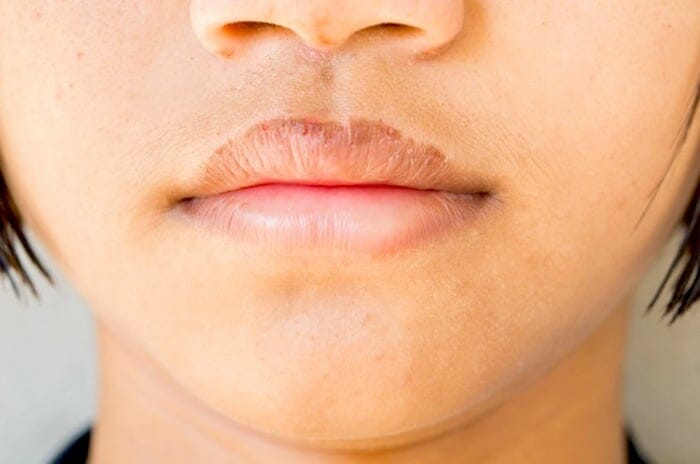 Eczema en los labios puede ocurrir debido a una reacción alérgica