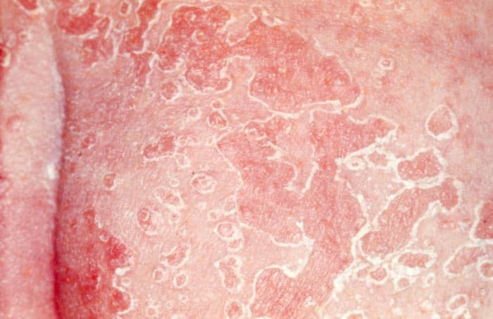 Candida es un tipo de levadura que causa una infección por hongos en el cuerpo