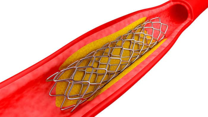 ¿Qué es un stent? Todo lo que necesitas saber