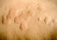 Tratamiento casero para la alergia en la piel
