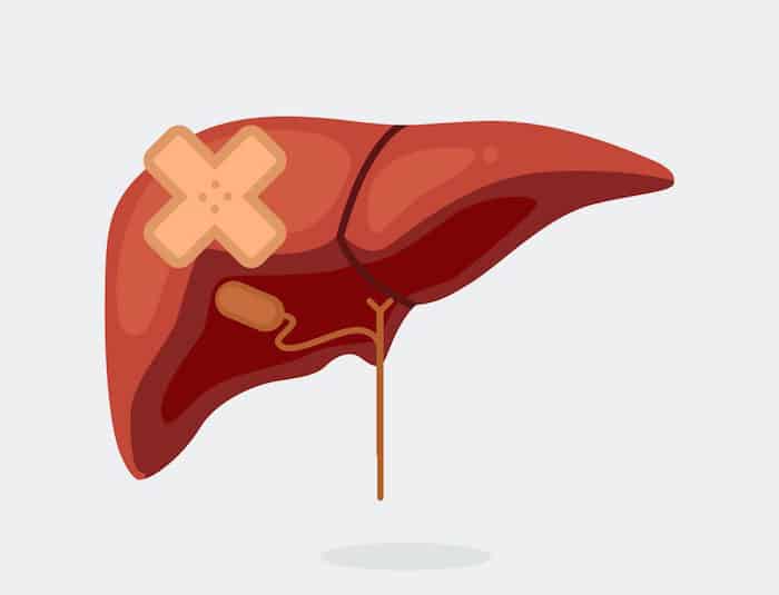 ¿Qué es la fibrosis hepática?